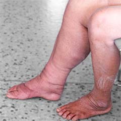 Lymphedema Leg